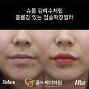 이현주치과의원 | 역삼동피부과 골드제이의원 Q&amp;A 슈룹 김혜수처럼 자연스러운 입술확장필러