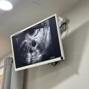 SK 금강치과의원 | 임신 준비 배란초음파 후기 강남 산부인과 첫걸음산부인과 추천 임신 성공 (배테기 비교)