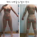 [S라인_김날씬] 전신지흡-수술 1, 2일차 이미지