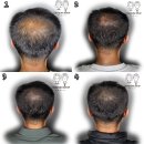 [일산 두피문신] 정수리▪헤어라인▪가르마 탈모, 자연스럽게 채운 방법 - 채움샵SMP