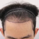 부산 맘모스헤어라인의원 이미지