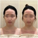 위뷰티 4번째 방문 얼굴경락마사지 입안마사지 윤곽 관리 성공