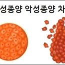양성종양 악성종양 차이 이미지