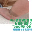 이소성몽고반점 레이저수술 보험금 받을 수 있나 이미지