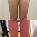 인핏짐 | 신사역성형외과 허틈 만들기 위해 인핏지방분해주사 하고 온 후기 공유