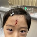 5살 아기 이마찢어짐(찍힘) 대전 양승돈성형외과에서 봉합 흉터관리
