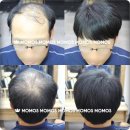 모모스가발 | 믿고 붙이는 붙임머리 대구 붙임머리 후기!!! 뜨아아!!!