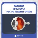 잠실소중안안과의원 | 잠실역망막안과 망막이 찢어져 구멍이 생기는 질환인 망막열공