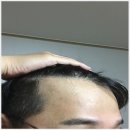 원형 탈모 초기 증상과 원인 치료 방법까지 알아보기