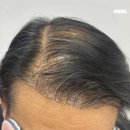 리아앤스칼프 | 대구두피문신후기, 전두부 숱채움 "미용실에서 인정했어요." 5회차(미완성)