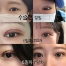 부산 눈재수술 쌍수 후기 짝눈 스트레스 탈출 + 코수술 만족 후기 내돈내산
