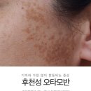 에스앤유피부과 - 성남시 분당구 황새울로200번길 9-7 | 공덕에스앤유피부과 오타모반 피코토닝 1회차 후기