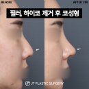 제이티성형외과의원 | 필러, 하이코 제거 후 코성형 | 퍼진 콧대와 처진 코끝 개선 사례_제이티성형외과