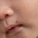 천사약국 | ① 아기 혈관종 레이저 시술 후기｜인천 송도 오라클 피부과 첫 방문 후기