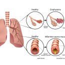 만성폐쇄성 폐질환(COPD) 이미지