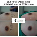 [남자유두축소수술전후] 26세 학생 175cm 83kg 9.5X10X7 mm → 5X5X3 mm - 1 이미지