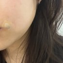 르아뷰티&솔에스테틱부산서면점 | 부산 서면 얼굴 점 제거 22,000원, 점 제거 후기(내 돈 내산)