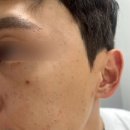 보정약국 | 노원.중계동 남자 기미잡티제거 완전 깨끗해짐. 톤보정+제로스팟후기!