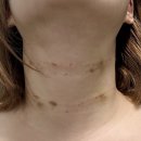 양이멍이 | 부평 피부과 목주름필러 맞은 생생후기