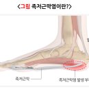 링게이트 이미지