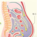 간암 치료 과정에서 복수가 찰 경우의 치료와 관리 방법 ​ 이미지