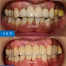 다솜임플란트치과기공소 | 연산역야간치과 40대 여성 앞니임플란트, 어금니임플란트 치료 사례