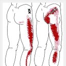 소둔근[Gluteus Minimus] 통증의 원인 이미지