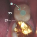 선진치과의원 | 망포역치과 임플란트 20년은 거뜬히 쓰는 비밀
