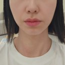 울산바노바기 슈링크 유니버스 솔직 후기 효과 및 통증
