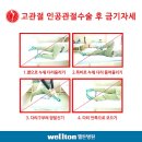 엉덩이 통증/ 무혈성골괴사 의심/ 수술 잘하는 곳에서 하자. 이미지