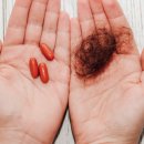 “탈모가 생존 문제냐”…탈모약 건강보험 추진에 “선심성” 비판 가중 이미지