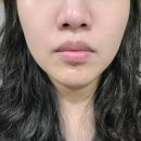 서피부과의원 | 분당/용인 죽전 피부과 추천_서울화봄의원(혈관종제거 후기)