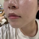 필바이오랩 주식회사 | [창원_상남동] 르네아바이더랩 / 창원 상남동 에스테틱 / 5회차 관리 후기 / 여드름 흉터