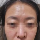 선릉탑비뇨기과의원 | 선릉 힐비뇨기과의원 잡티제거 후기