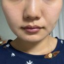 맨앤우먼의원 | 보조개 시술 부작용 볼패임, 볼꺼짐 자연스럽게 해결한 홍대 앤봄의원 옆볼필러 솔직후기