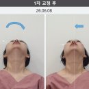 허뤼업체형교정전문 | 단 하루만에 턱관절 안면비대칭 및 두상 교정하기 (feat. 수원 턱관절 연예인 교정 한의원 실제 후기)