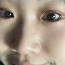 [etc] 눈 앞머리 비립종 안과 제거 후기 내돈내산 (평촌역 삼성밝은안과의원)