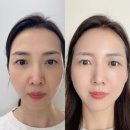 원더디자인 | 팔자주름 실 리프팅 끝판왕 원더트리플 내돈내산 후기, 가격, 부작용 - 실루엣소프트와 비교