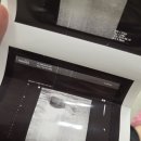 땡큐약국 | 이하선종양 발견부터 이하선종양 수술까지, 땡큐서울의원(1)