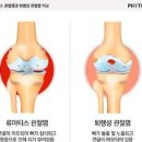 손가락 관절염 류마티스 관절염 (류머티스) 이미지