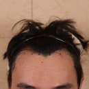 움찬의원 | 움찬의원 모발이식 절개 3500모 후기