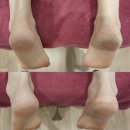 H.FIT운동센터 | 뒤꿈치 각질, 걷는 습관 때문일 수도 있어요! 울산 R&amp;H운동센터 후기