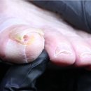 홀드핀칭 이미지