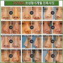 수원-0474 | 자가진피 코성형 안전하게!