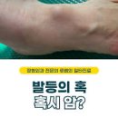 아킬레스건염 증상 발목 물혹 결절종 차이 이미지