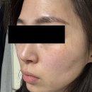 루비약국 | 루나의원-루비레이저 후기