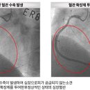 변이형(이형성) 협심증, 독특한 증상의 이해와 효과적인 관리 이미지