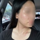 대구 얼굴전체 목전체 편평사마귀 쥐젖 - 신세계가정의학과 무료리터치 받은 후기