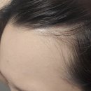 라인메드 | 탈모관리 정수리탈모 두피앰플 트리카메드 사용후기