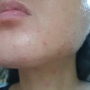 티디 | 다이소 바이오디-티디 스팟 카밍젤 후기｜좁쌀여드름 응급 진정템✨